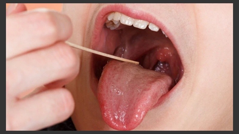 En general, los casos de fiebre y dolor en garganta son de origen viral.