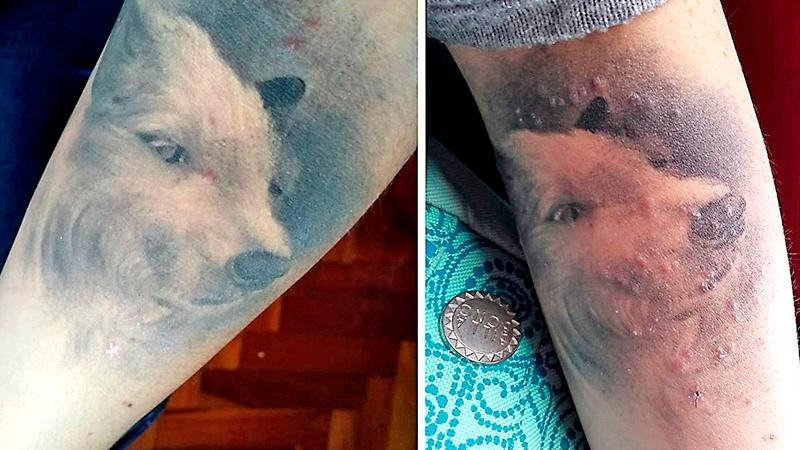 El tatuaje tatuaje, antes y después de la bacteria. 