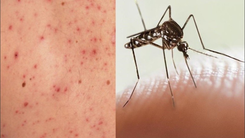 Dos muertes por sarampión y dengue en Buenos Aires. 